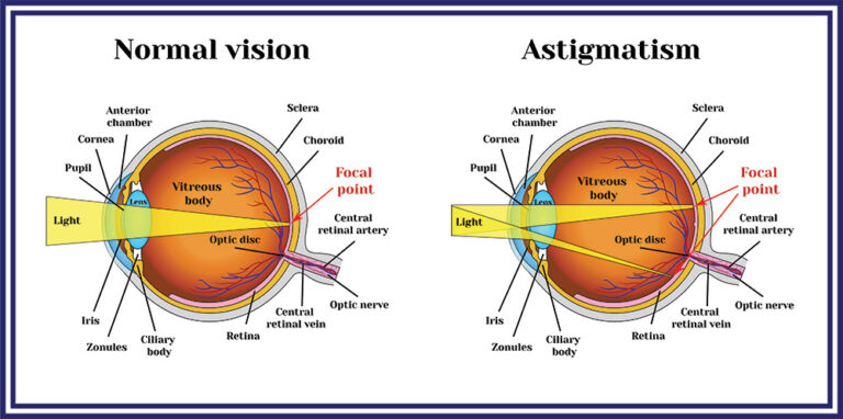 Refractive errors eyeball. Astigmatism.