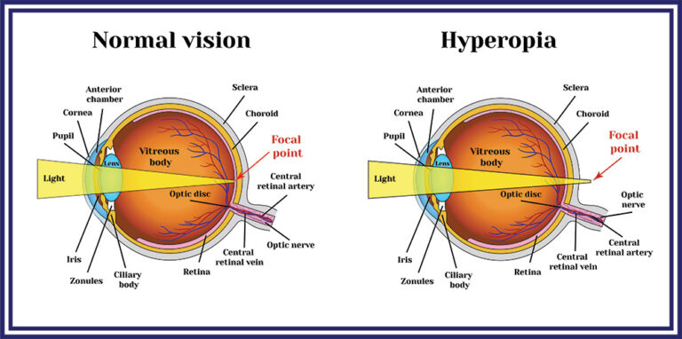 Refractive errors eyeball. Hyperopia.