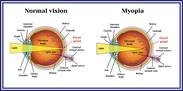 Refractive errors eyeball. Myopia.